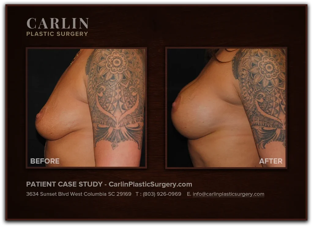 Breast Lift with Augmentation before and after — patient 04, left view