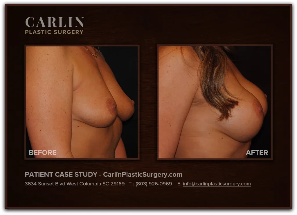 Breast Lift with Augmentation before and after — patient 04, right profile view