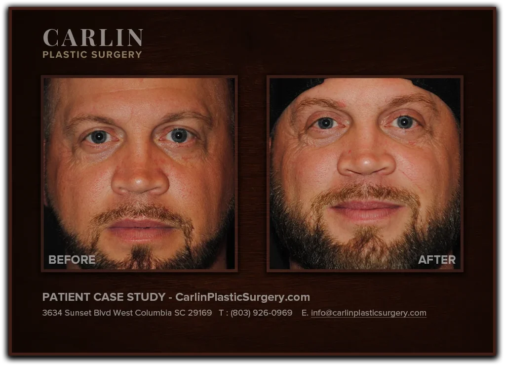Upper Eyelid Surgery before and after — patient 10, front view