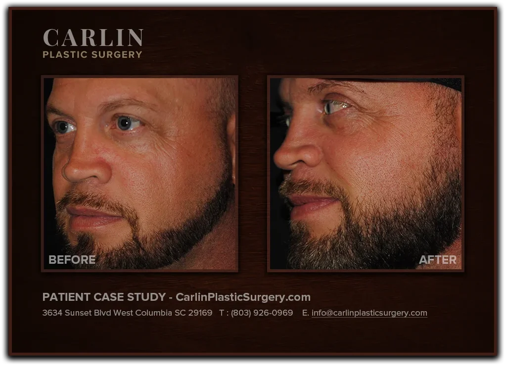 Upper Eyelid Surgery before and after — patient 10, left profile view