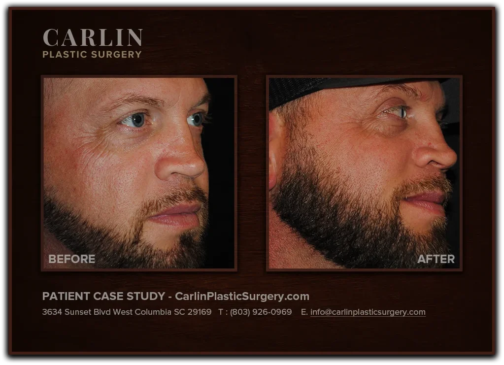 Upper Eyelid Surgery before and after — patient 10, right profile view