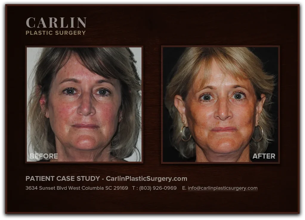 Facelift with Upper & Lower Eyelid Surgery before and after — patient 09, front view
