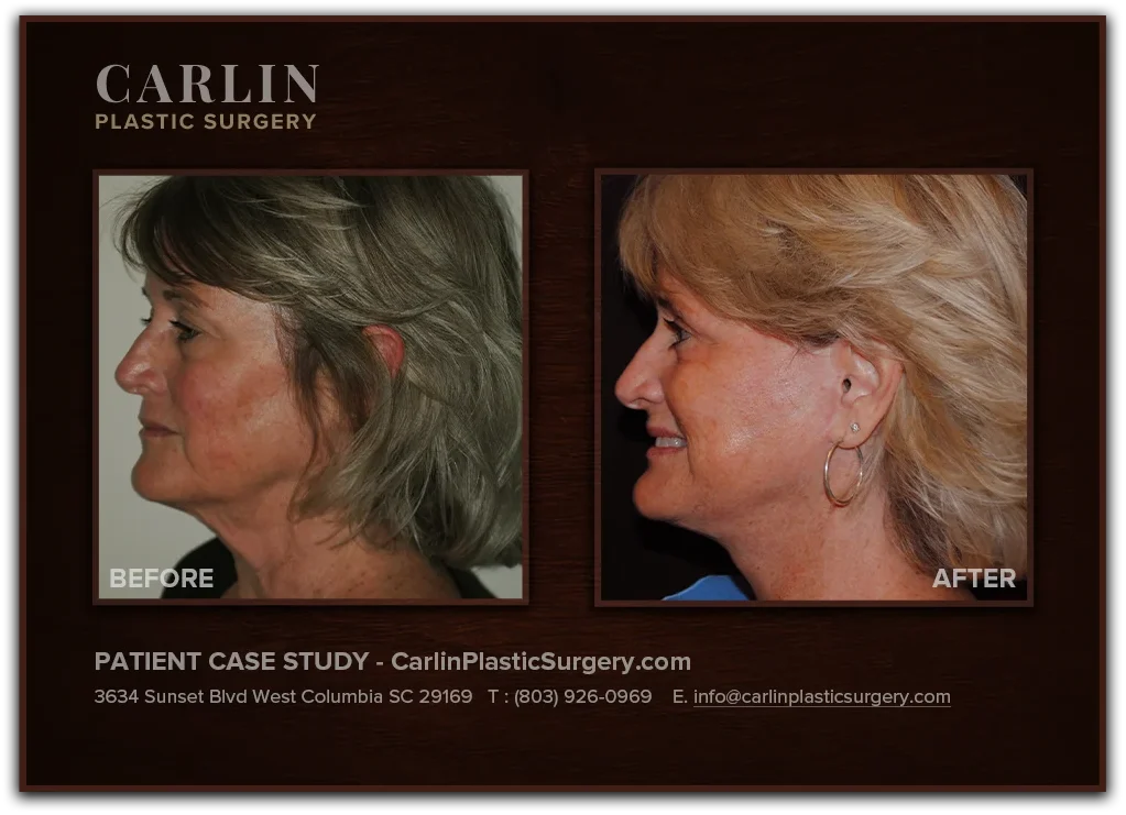 Facelift with Upper & Lower Eyelid Surgery before and after — patient 09, left profile view