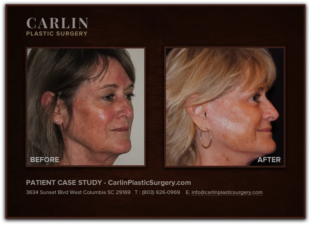Facelift with Upper & Lower Eyelid Surgery before and after — patient 09, right profile view