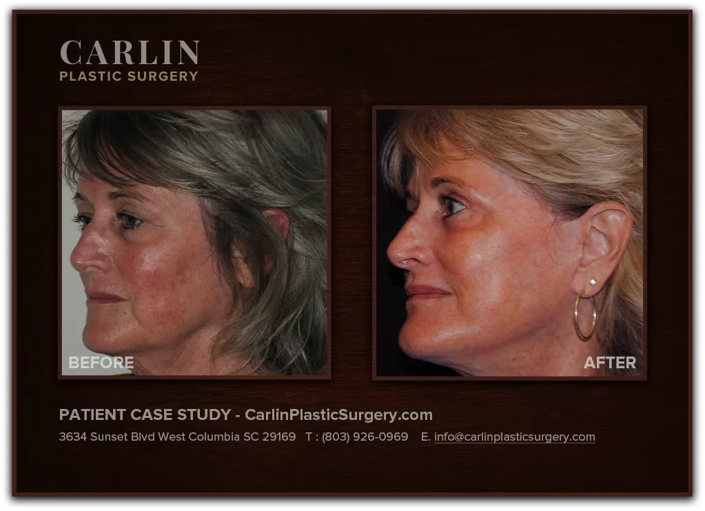 Facelift with Upper & Lower Eyelid Surgery before and after — patient 09, side view